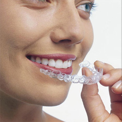 invisalign01